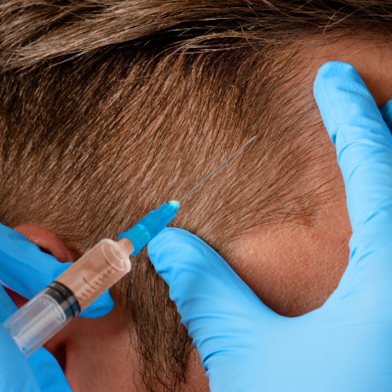 PRP hair restoration
